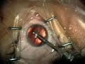 Phaco Supracapsular Flip Carousel - Viscoat, Dennis Lu, M.D.