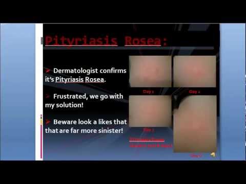 how to treat pityriasis rosea