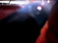 Laparoscopic Appendectomy