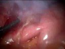 Laparoscopic Appendectomy