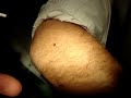 Evaporation des verrues et noevus par le laser MULTILINE™ à Paris