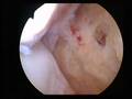 Arthroskopie OSG
