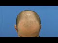 Hair Transplant - \"SO\ Hair Transplant - \"SO\