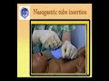 Pediatric NGT#
