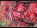 Extreme Lateral Transcondylar Approach: Meningioma of the CVJ & Upper Cervical Spine