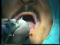 3D computer guided dental implant surgery