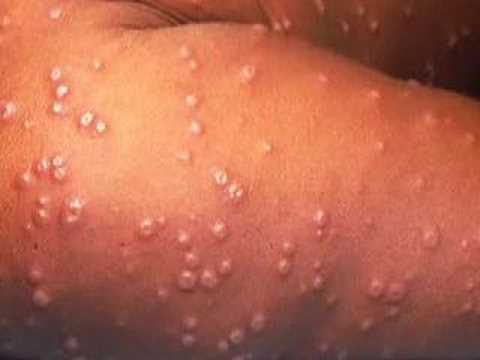 Smallpox - The Greatest Battle of ...