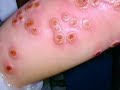 Smallpox - The Greatest Battle of Mankind