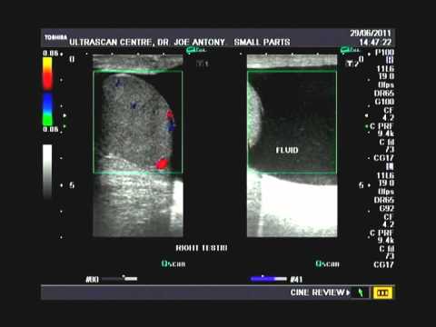 how to cure epididymal cyst