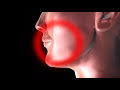 Canker Sore Treatment animation www.cankercover.com Canker Sore