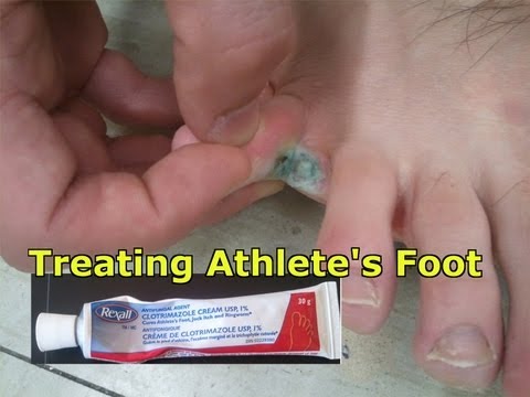 how to treat itchy feet