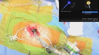 Navigated Primary Hip Replacement through a Direct Anterior Approach – 06/20/2014