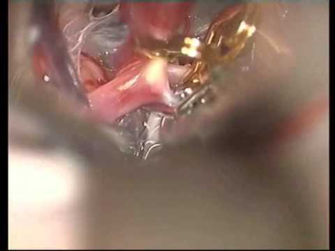 Previously Coiled Aneurysms Microsurgery - Experience on group of 81 patients - Video 3