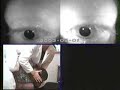 Horizontal Canal BPPV