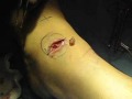 excision 1
