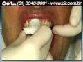 Clareamento dental a laser