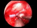 Endoscopic Method Performed On The Disc