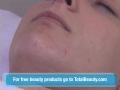 How to Extract a Blackhead Properly