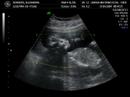Ecografia bebe Olea Borrero