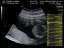 Ecografia bebe Olea Borrero