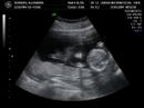 Ecografia bebe Olea Borrero