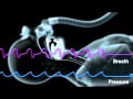 ResMed S9 Series: Enhanced Autoset Algorithm Technology