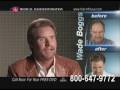 videos de Reasons for hair loss