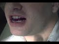 Somnomed mandibular advancement device fitting part 2 Somnomed mandibular advancement device fitting part 2