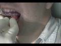 Somnomed mandibular advancement device fitting part 2