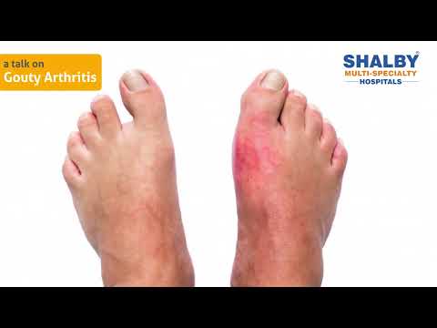 Gouty Arthritis (Gout): Symptoms & Treatment