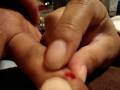 videos de finger blister
