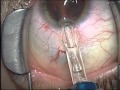 The Fladen Eye and Lasik Center: Phakic Intraocular Lens Implant (ICL)