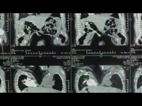 Conjoined twins separated in groundbreaking surgery