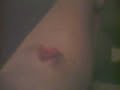 leg biten by shark