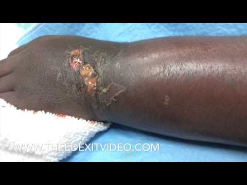 how to drain cellulitis