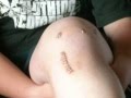 ACL reconstruction View Video