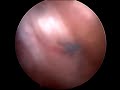 ACL surgery 5/6