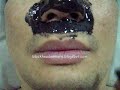 http://blackheadnomore.blogspot.com

This is the real art of extracting blackheads. Squeezing will cause infection & scars. Pore strips don't work. Scrubbing won't help. 

The only cure that has worked so well for me is The BLAKhead Masque!

This video is taken to show you how to use the masque. I use it twice a week & now I've got less blackheads to extract !

To buy this product, go to the link above & click 'Buy Now' at the right column.