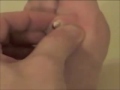Popping a nasty cyst