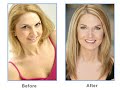 Laser Whitening