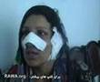 Nose and ear of an Afghan woman is cut off by her husband
