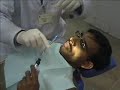 Cross Infection Control Guidelines for Amalgam Restorations