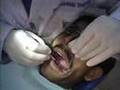 Cross Infection Control Guidelines for Amalgam Restorations
