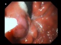 Endoscopic Injection of Nectacryl Glue Endoscopic Injection of Nectacryl Glue