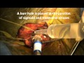 Retrosigmoid approach for resection of cerebellopontine angle meningioma