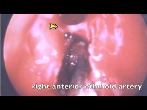 how to overcome nose bleed