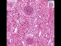 Histopathology Kidney--Microscopic polyarteritis