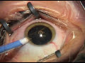 ICL Visian implantation - side view II