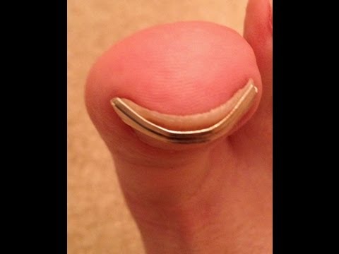 how to fix ingrown toenail