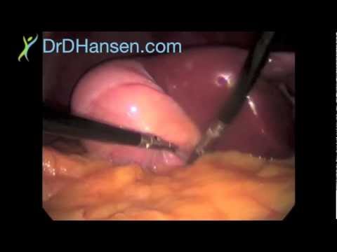 how to perform gallbladder surgery